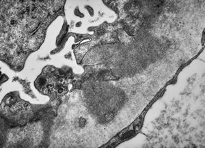 F,74y. | membranous glomerulopathy